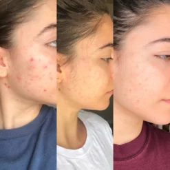 Bl+C Pimples Serum Concentrate 14 Bl+C Pimples Serum Concentrate -Fashion Makeup & Care Bl CSerum Lifestyle3