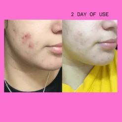 Pimple Paste Overnight Drying Paste -Fashion Makeup & Care NEWBAFORSHOPIFY