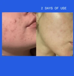 Pimple Paste Overnight Drying Paste -Fashion Makeup & Care NEWBAFORSHOPIFY1