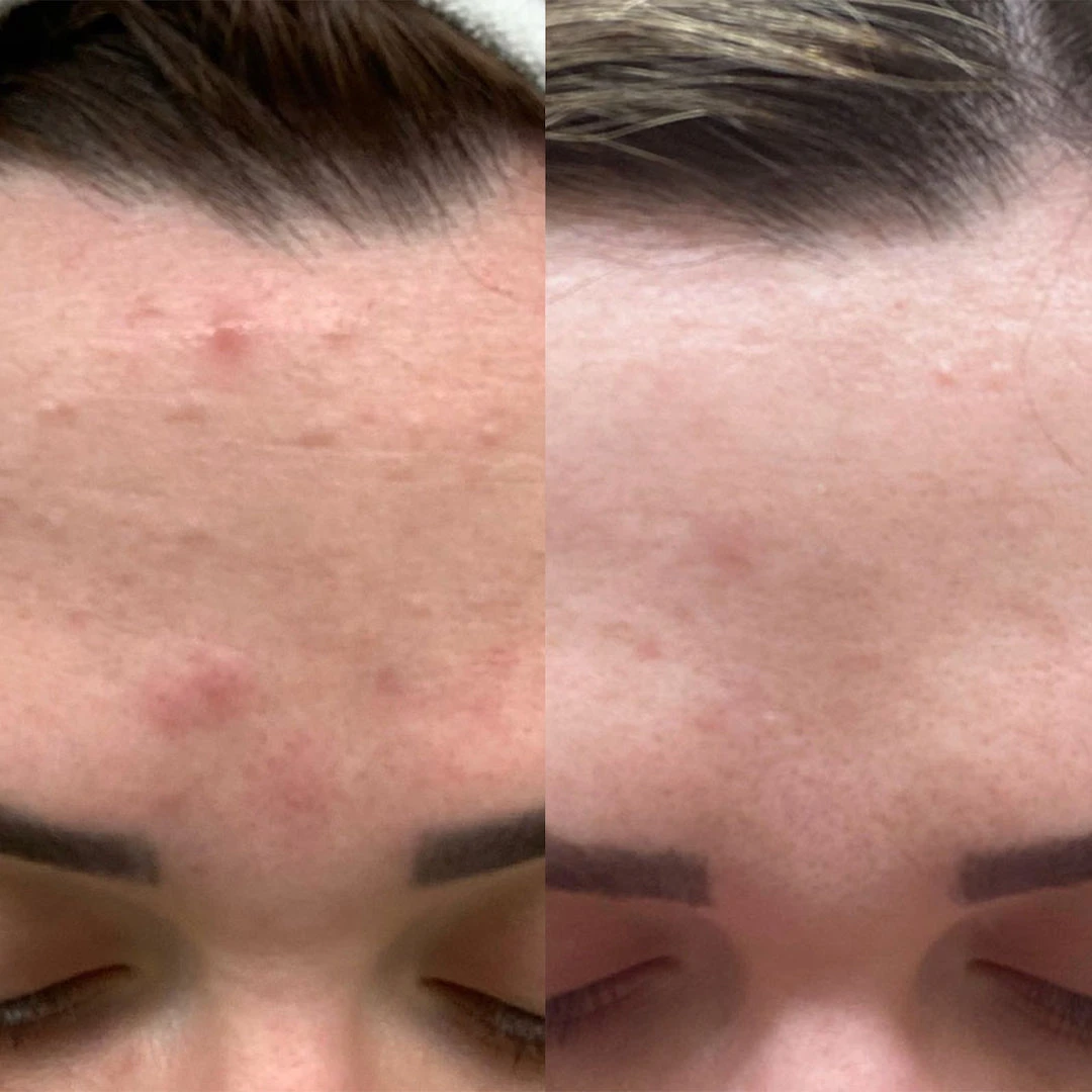 Bl+C Pimples Serum Concentrate 9 Bl+C Pimples Serum Concentrate - Image 9