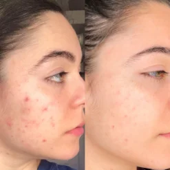 Bl+C Pimples Serum Concentrate 19 Bl+C Pimples Serum Concentrate -Fashion Makeup & Care NatalieSidebySide