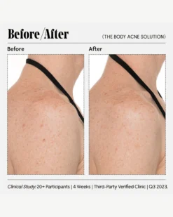 The Body Acne Solution 13 The Body Acne Solution -Fashion Makeup & Care Necessaire RetailerGraphics 2023 TheBodyAcneSolution 07 scaled