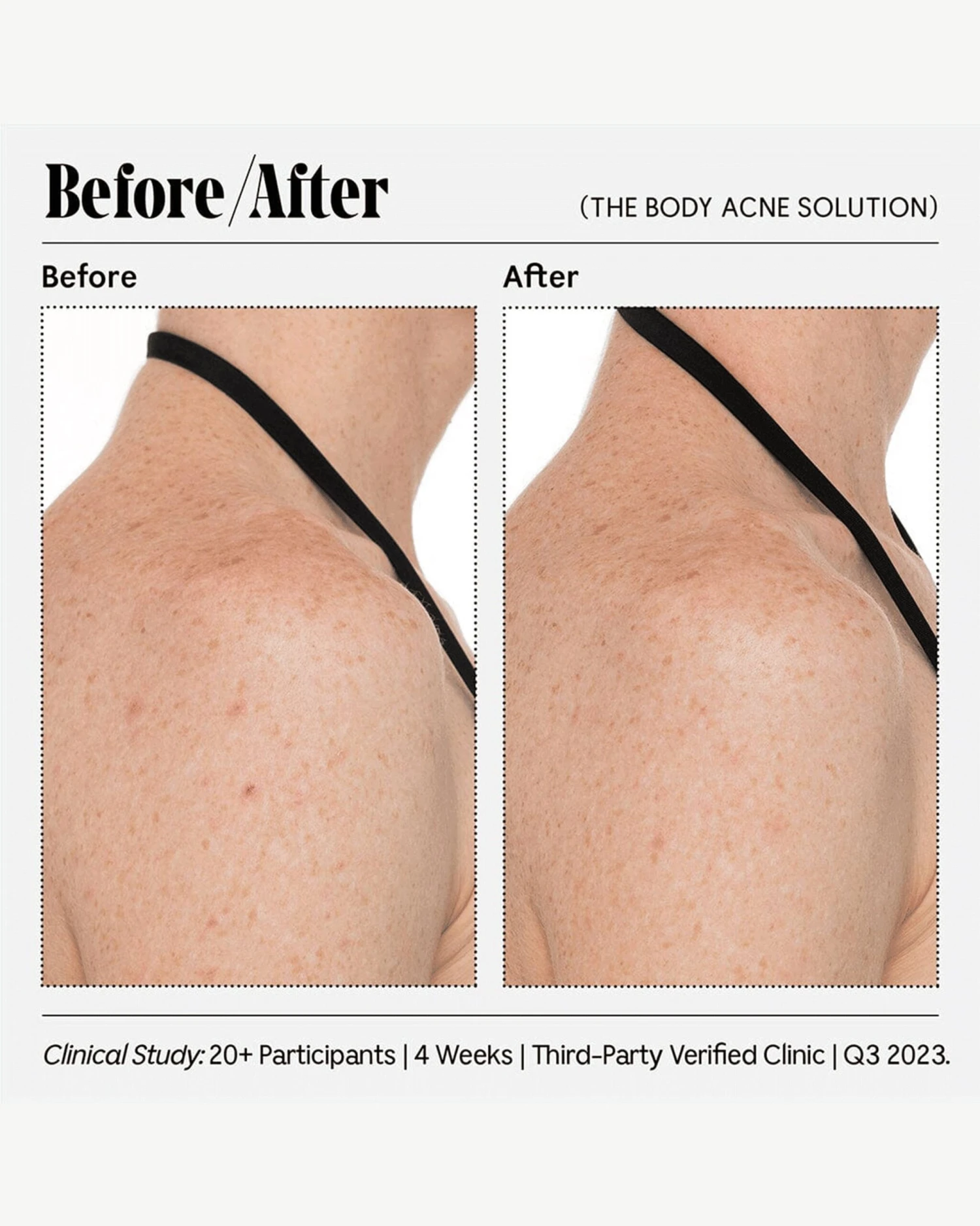 The Body Acne Solution 3 The Body Acne Solution - Image 3