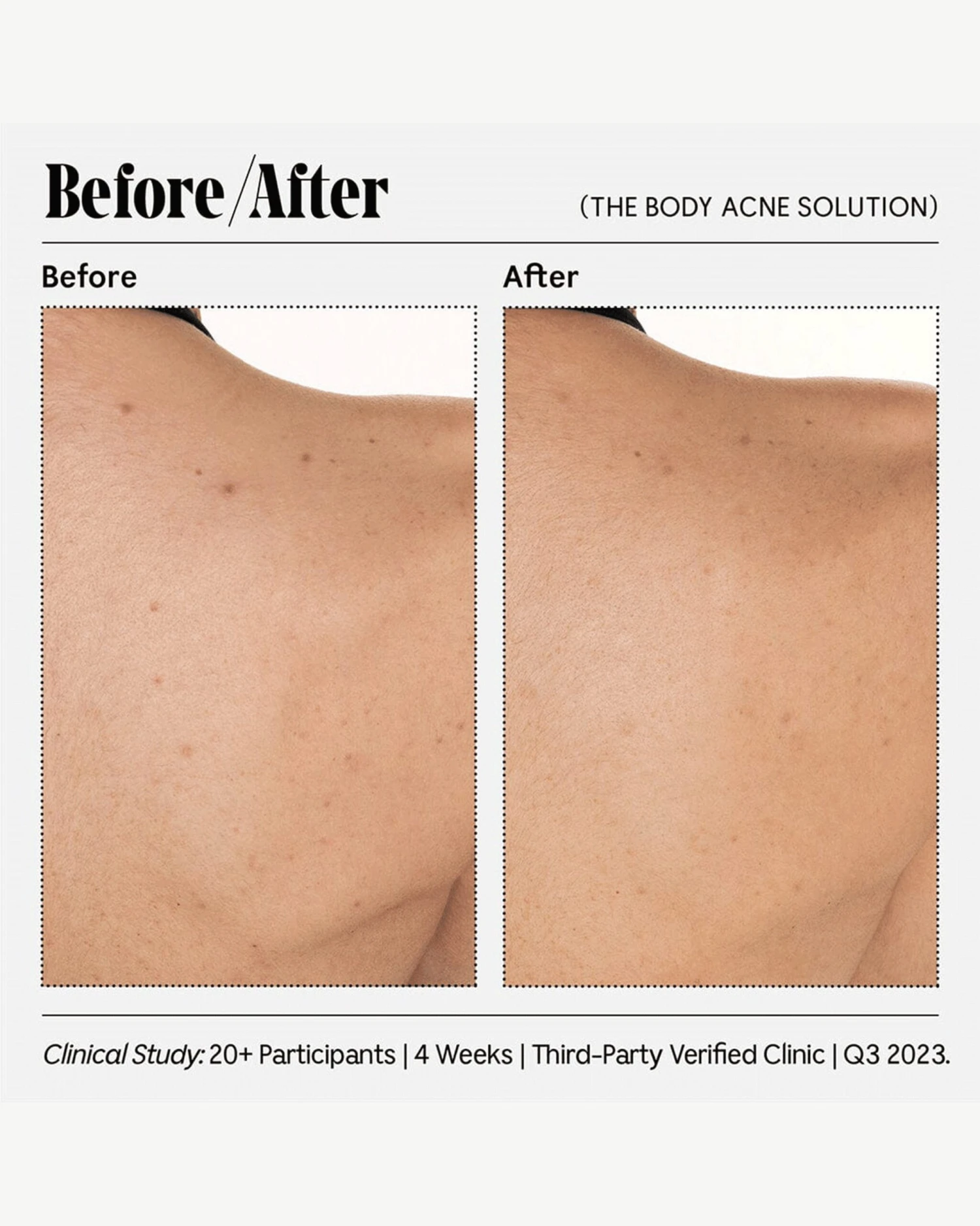 The Body Acne Solution 2 The Body Acne Solution - Image 2
