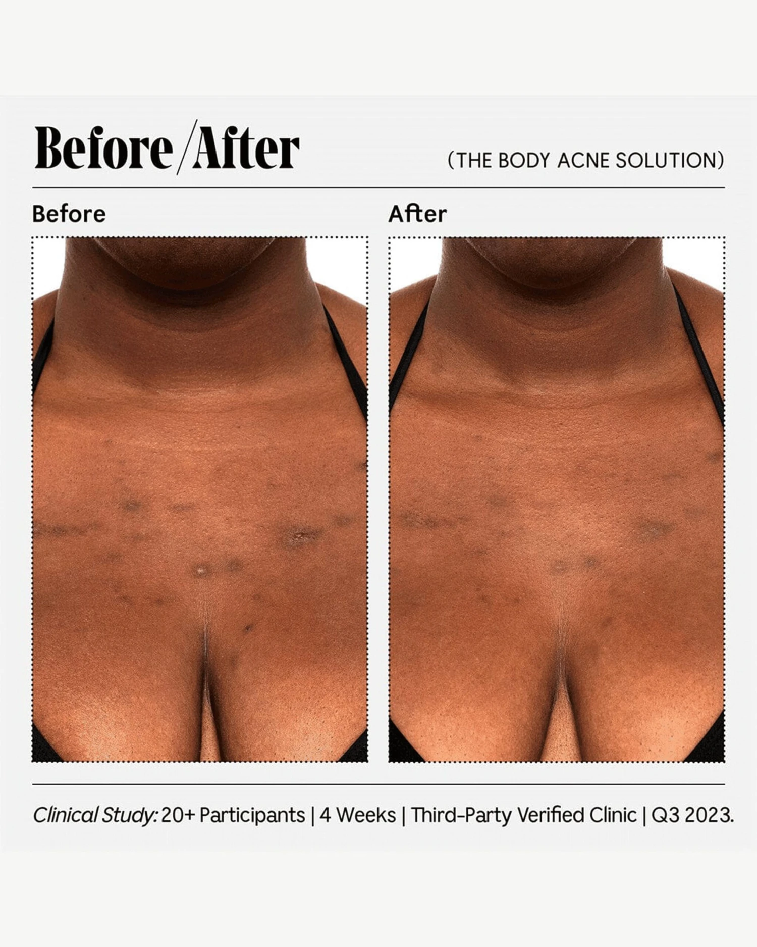 The Body Acne Solution 4 The Body Acne Solution - Image 4
