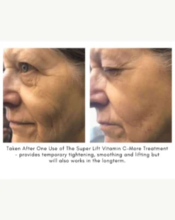 The Super Lift Vitamin C-More Treatment 20 The Super Lift Vitamin C-More Treatment -Fashion Makeup & Care SUPERLIFTCASESTUDY3