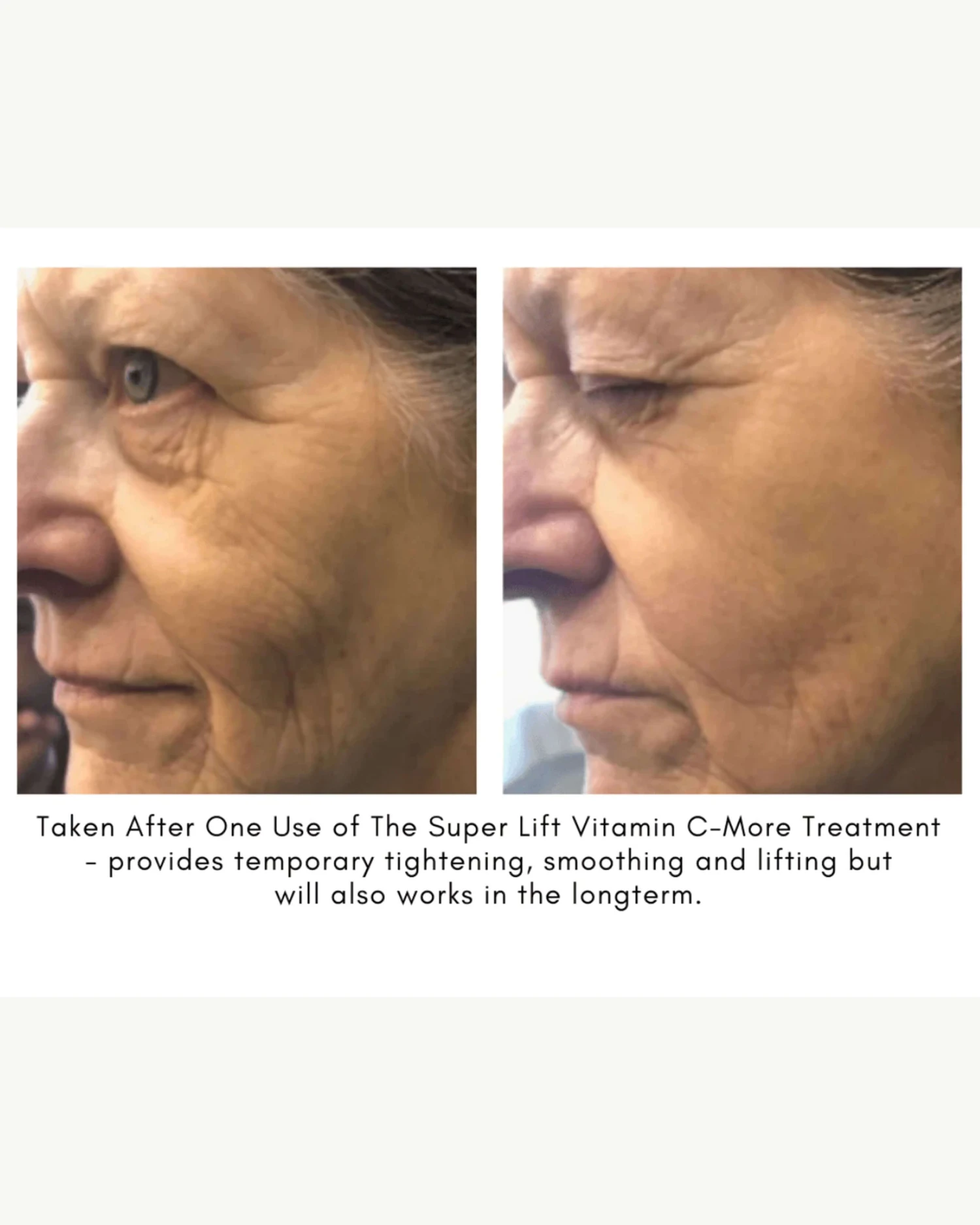 The Super Lift Vitamin C-More Treatment 10 The Super Lift Vitamin C-More Treatment - Image 10