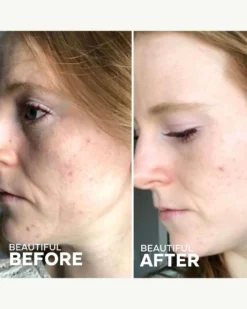 Refresh Papaya + Salicylic Acid Cleanser 12 Refresh Papaya + Salicylic Acid Cleanser -Fashion Makeup & Care ThreeShips RefreshCleanser BeforeAfter 04 scaled