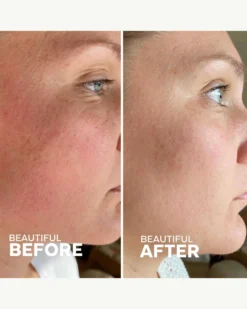 Skin Hero Bakuchiol + Calendula Bio-Retinol Serum 9 Skin Hero Bakuchiol + Calendula Bio-Retinol Serum -Fashion Makeup & Care ThreeShips SkinHeroSerum BeforeAfter 06 scaled